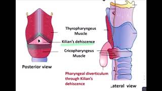 ESOPHAGEAL DIVERTICULUM [upl. by Janey]