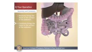 ColostomyIleostomy Your Operation [upl. by Ivo]