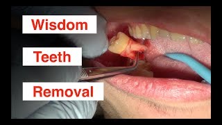 Wisdom Teeth Removal [upl. by Nilyahs]