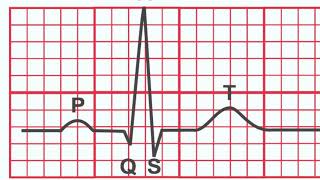 Normal EKG vs Heart Attack [upl. by Schumer]