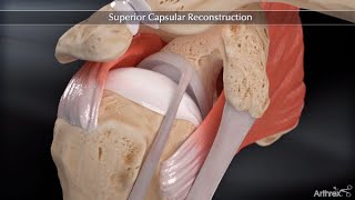 Superior Capsular Reconstruction Animation [upl. by Cramer898]