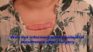 Chest Keloids  Mistakes to Avoid [upl. by Alamap599]