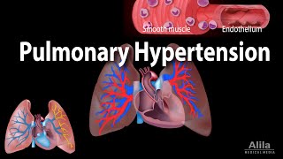 Pulmonary Hypertension Animation [upl. by Brewster354]