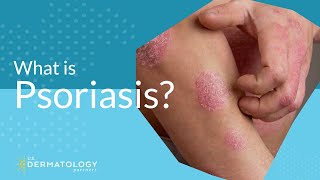 What Is Psoriasis [upl. by Zipporah93]