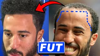 Andros Townsend FUT Hair Transplant Transformation [upl. by Samuele]