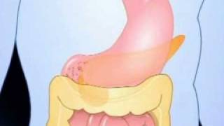 Diagnosis of Type 2 Diabetes [upl. by Carroll]