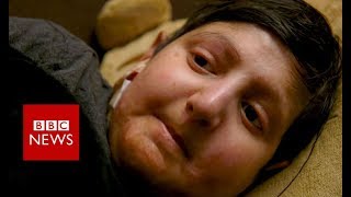 My life without skin  BBC News [upl. by Eaves]