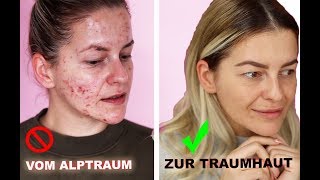 ❗️ In NUR 3 Monaten zur TRAUMHAUT  HEFTIGES Ergebnis ❗️ Microneedling Vorher Nachher Diana Delo [upl. by Lyns975]