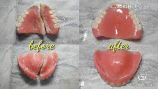 How to repair and clean a fractured complete upper denture [upl. by Enelear]