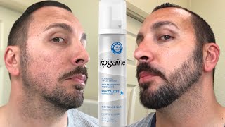 How to grow a REAL Beard  Minoxidil 4 Month Beard Journey [upl. by Aker311]