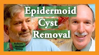 Cysts extractions blackheads  Removal methods in HD [upl. by Liggitt135]