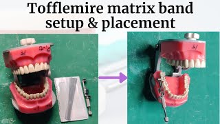 Tofflemire Retainer Parts Matrix Band setup and placement  Universal Matrix  Matricing [upl. by Delisle138]