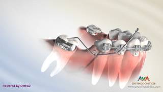 Orthodontic Treatment for Molar Uprighting  Cantilever Spring [upl. by Rosmunda487]