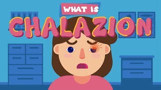 What is Chalazion [upl. by Baptiste]