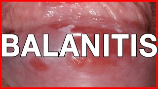 Balanitis Symptoms Causes Treatment and Prevention [upl. by Moorish]