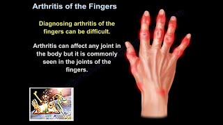 Arthritis Of The Fingers  Everything You Need To Know  Dr Nabil Ebraheim [upl. by Yeslah]