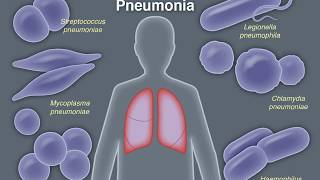 Treating CommunityAcquired Pneumonia [upl. by Otsedom]