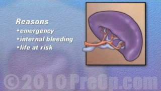 PreOp® Patient Education Spleen Removal Laparoscopic Splenectomy 2 [upl. by Dnomra]