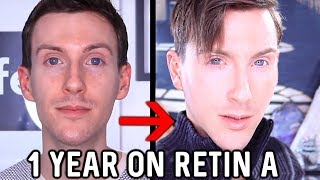 MY 1 YEAR RETINA RESULTS  BEFORE AND AFTER TRETINOIN [upl. by Ellened86]