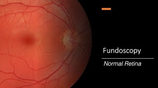 Healthy Retina Fundoscopy [upl. by Adkins506]