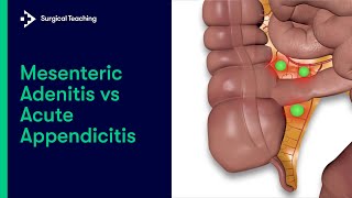 How to identify gallstone pain and appendicitis pain  Dr Nanda Rajaneesh  Doctors Circle [upl. by Apurk508]