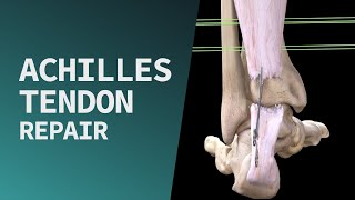 Achilles Tendon Repair [upl. by Donnelly]