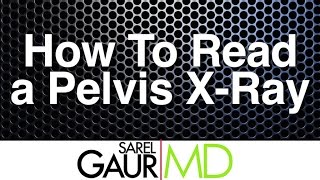 How to Read a Pelvis Xray [upl. by Faria]