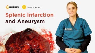 Splenic Infarction and Aneurysm  General Surgery Lectures  Student Education  VLearning [upl. by Rogerg]