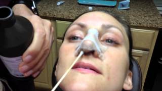 What is Rhinoplasty About the Nose Procedure and Recovery [upl. by Prospero]