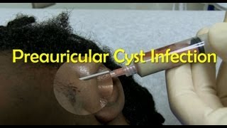 Preauricular Cyst Infection Management [upl. by Karly]