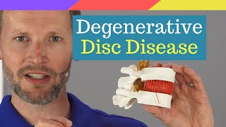 Explained Degenerative Disc Disease [upl. by Ahsinak]