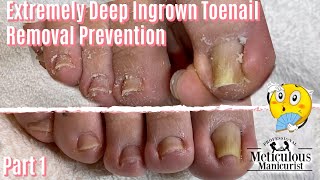 Salon Pedicure Ingrown Toenail Removal Prevention Transformation Part 1 [upl. by Takeshi714]