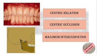 Centric Relation  Centric Occlusion  Maximum Intercuspation [upl. by Arther]