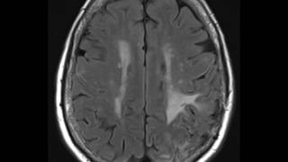 Amyloid Angiopathy [upl. by Mac]