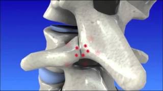 Degenerative Disc Disease  Spine Degeneration [upl. by Jolie]