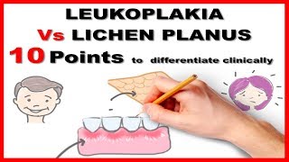 leukoplakia vs lichen planus  10 points to differentiate clinically [upl. by Hgielanna]