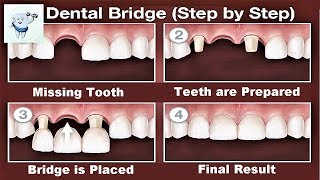 Dental Bridge Procedure Step by Step [upl. by Nolyak857]