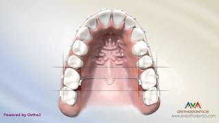 Orthodontic Space Management  TPA Appliance [upl. by Nalo690]