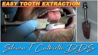 Easy Tooth Extraction  Dental Minute with Steven T Cutbirth DDS [upl. by Daffi]