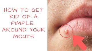 Eczema on lips causes symptoms treatment remedies prevention  Lip dermatitis Lip Cheilitis [upl. by Eetsirk921]