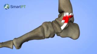 Medial Ankle Sprain [upl. by Brathwaite211]