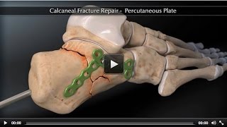 Calcaneal Fracture Percutaneous Plate [upl. by Lindley]