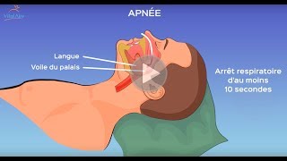 L’apnée du sommeil qu’estce que c’est [upl. by Claybourne]