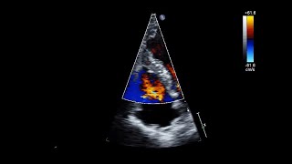 Ventricular Septal Rupture After Acute Myocardial Infarction [upl. by Leopoldeen]