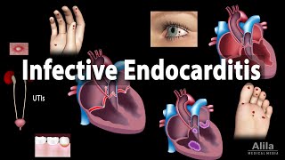 Infective Endocarditis Animation [upl. by Lehteb]