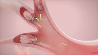 How It Works Zephyr Valve Treatment for COPD amp Emphysema [upl. by Herold]