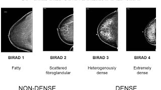 Breast Benign Tumours  Pathology mini tutorial [upl. by Cerelly]