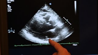 Echocardiogram Demonstration [upl. by Hen331]