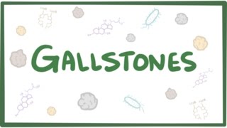 Gallstones cholelithiasis [upl. by Lashar]