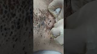 Nevus Comedonicus removal [upl. by Notsle975]